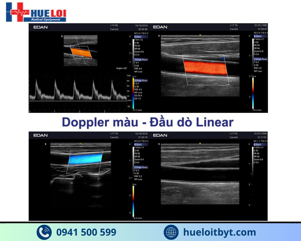 MÁY SIÊU ÂM HÌNH ẢNH EDAN AX3 CAO CẤP