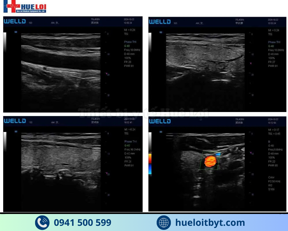 MÁY SIÊU ÂM XÁCH TAY CẢM ỨNG 2 ĐẦU DÒ P10
