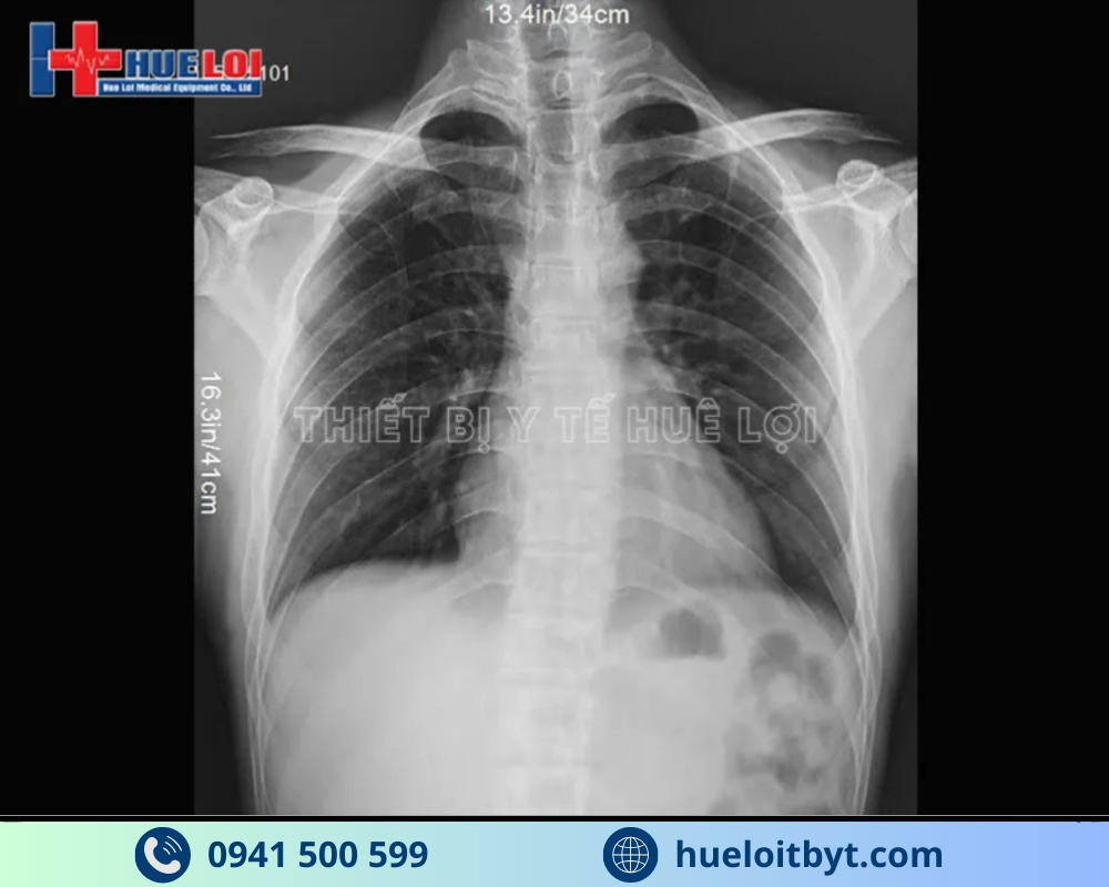 HỆ THỐNG X-QUANG KỸ THUẬT SỐ CỐ ĐỊNH YOLONG