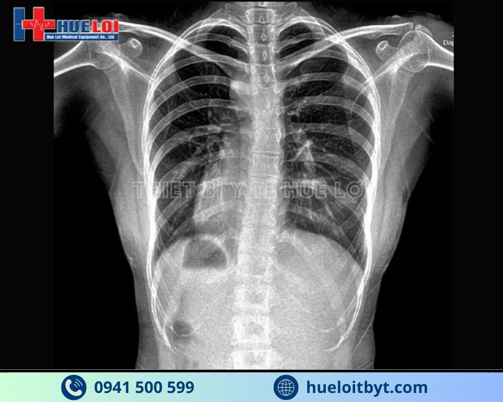 HỆ THỐNG X-QUANG KỸ THUẬT SỐ CỐ ĐỊNH YOLONG