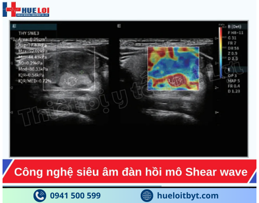 MÁY SIÊU ÂM CHẨN ĐOÁN CAO CẤP EDAN ACCLARIX LX85