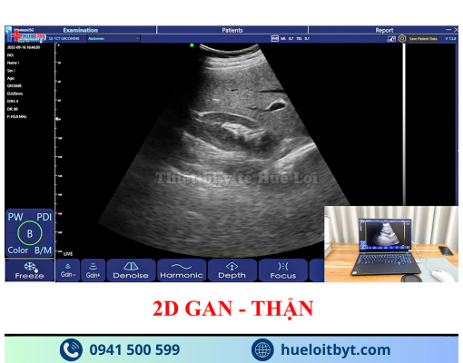 MÁY SIÊU ÂM CẦM TAY KHÔNG DÂY 3 ĐẦU DÒ