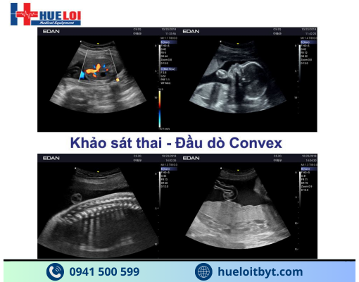 MÁY SIÊU ÂM HÌNH ẢNH EDAN AX3 CAO CẤP