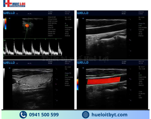 MÁY SIÊU ÂM XÁCH TAY CẢM ỨNG 2 ĐẦU DÒ P10