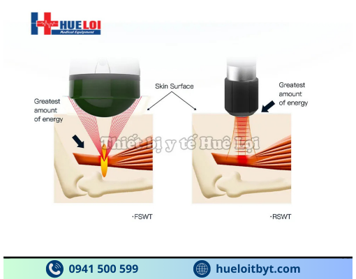MÁY XUNG KÍCH HỘI TỤ CAO CẤP EMFOCUS-I