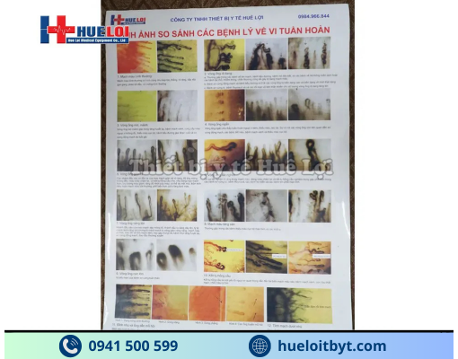 KÍNH HIỂN VI SOI MẠCH MÁU ĐỘ PHÓNG ĐẠI CAO